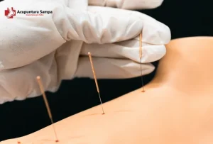 Acupuntura Sampa