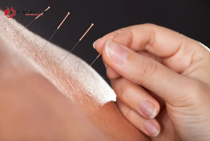 Quais pontos de acupuntura são usados para tratar constipação intestinal?