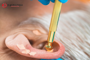 Auriculoterapia Acupuntura.Sampa.br